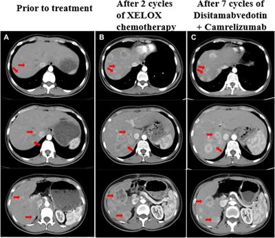 Case report: Remarkable response to later-line surufatinib in an adult patient with liver metastatic of pancreatoblastoma